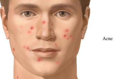 MALATTIE CUTANEE – 15 borse di studio per giovani dermatologi italiani grazie al sodalizio LEO Pharma – SIDeMaST