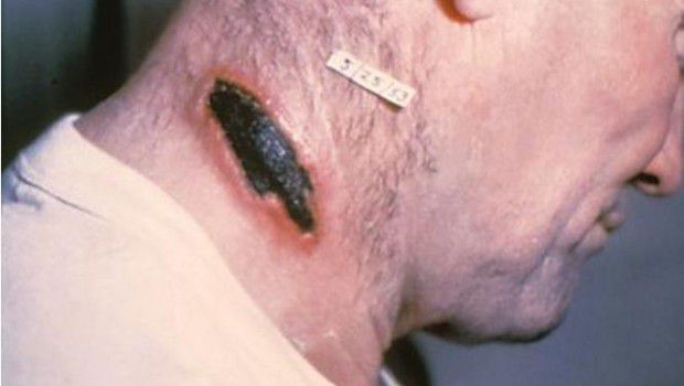 EPIDEMIE PERICOLOSE – Attenzione, a rischio latte, formaggi e carne delle zone di Randazzo, Bronte e Maniace perché c’è il carbonchio