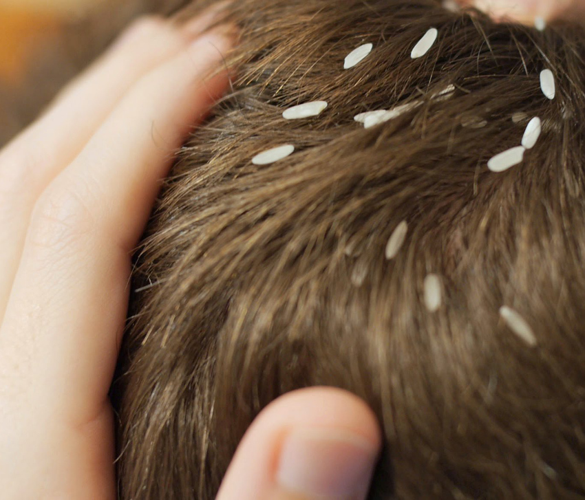 PIDOCCHI – Le direttive, a Brolo, tra interventi e prevenzione, per arginare il fenomeno